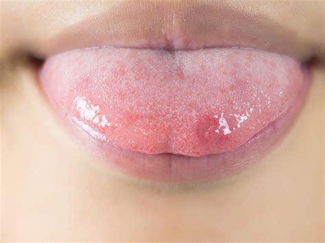 What Causes Canker Sores On My Tongue